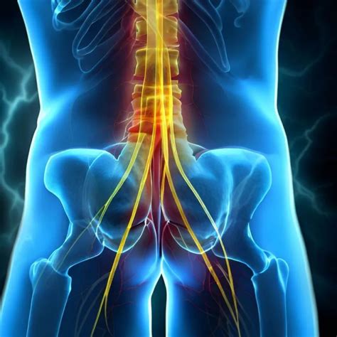 poze cu nervul sciatic|Nervul sciatic